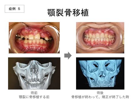 下巴有窩|顎裂